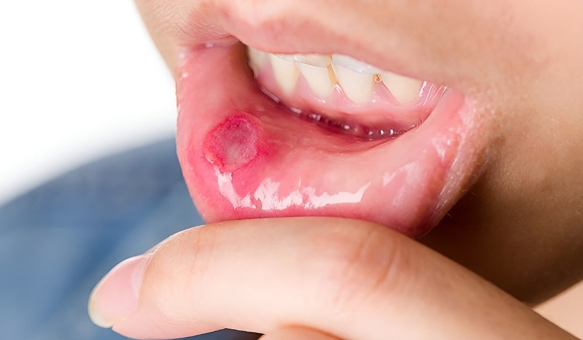 درمان سریع آفت دهان