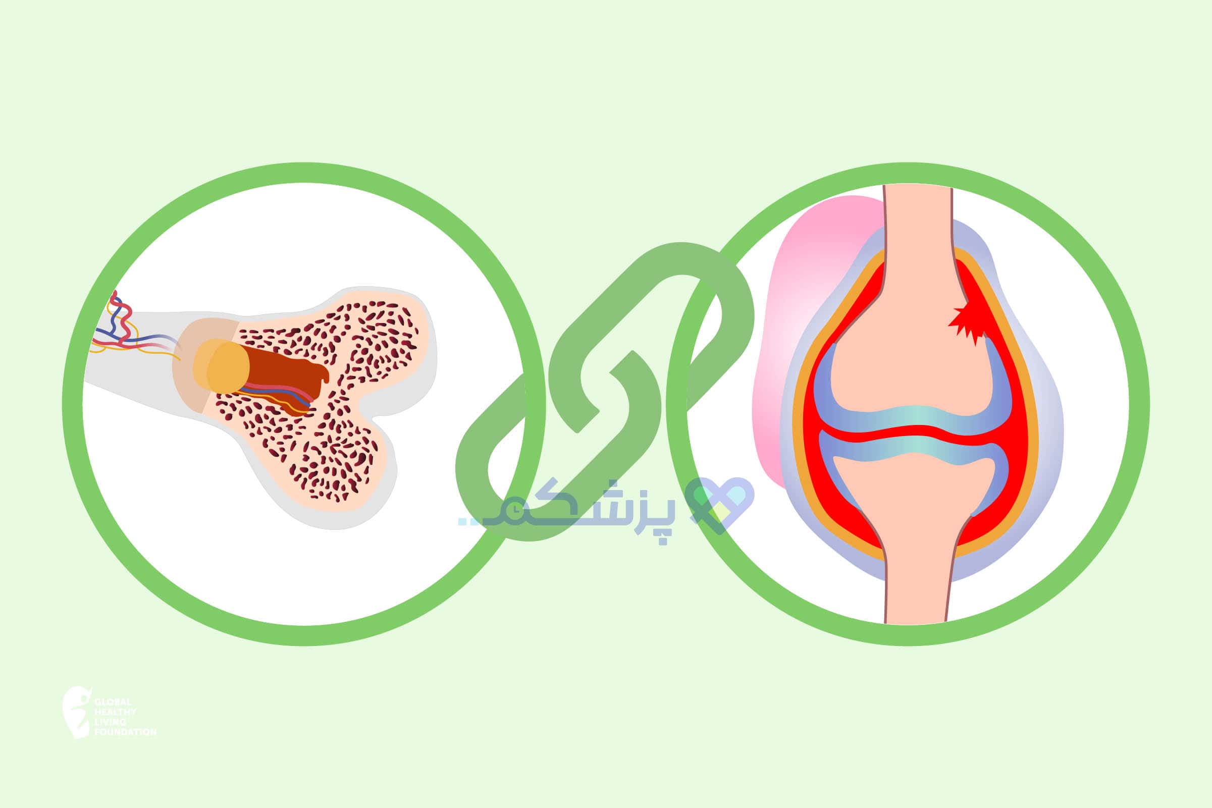 تفاوت پوکی استخوان و آرتروز چیست و بهترین روش درمان هر کدام