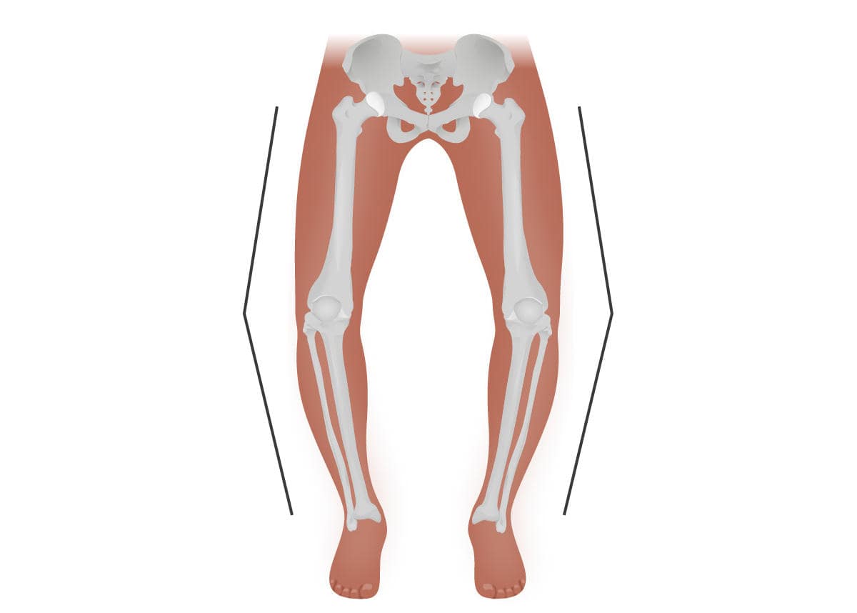 بهترین روش درمان پای پرانتزی چیست؟