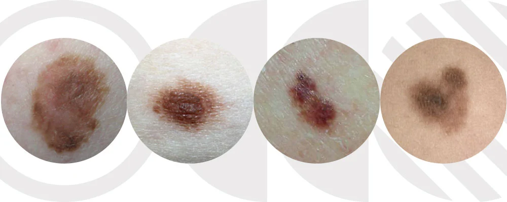 علائم خال سرطانی