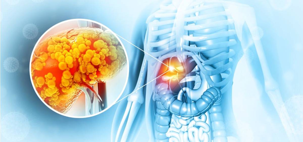 چطور بفهمم کبد چرب دارم