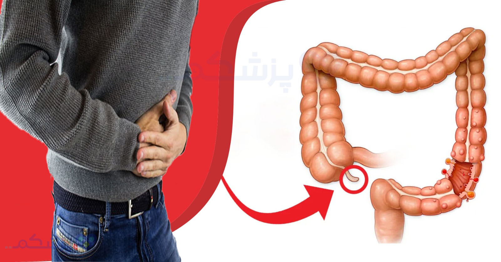 علائم آپاندیس، تشخیص آپاندیس در منزل